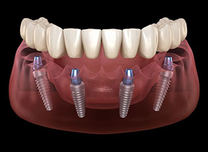 All on 4 Dental Implant