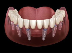 All on 6 Dental Implant