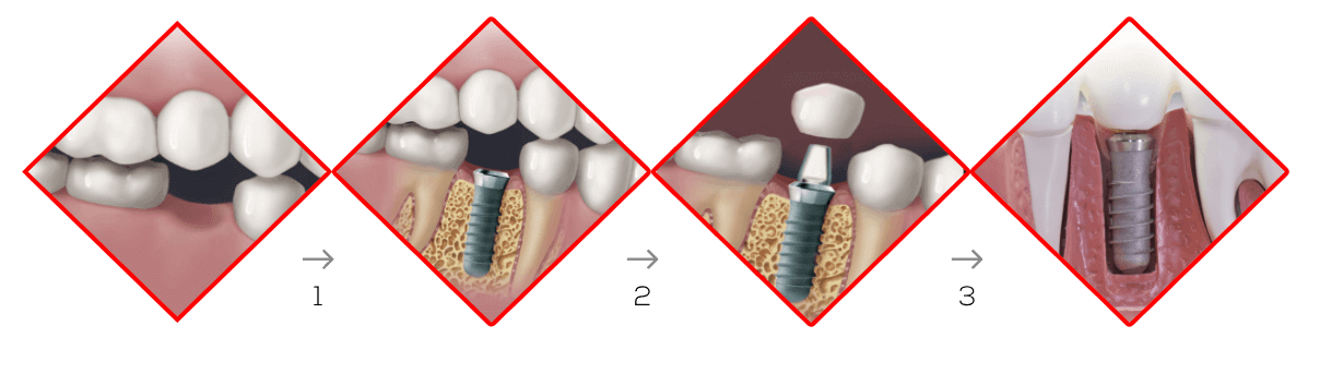 Dental Implant Treatments procedure