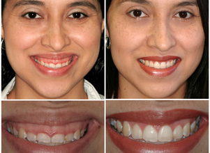 Smile Makeover and Smile Designing