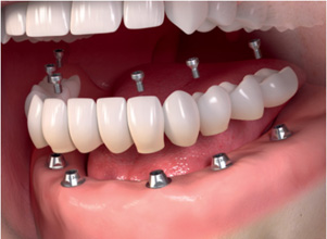 all on 4 implant