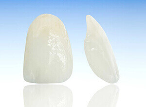 Ceramic Veneers