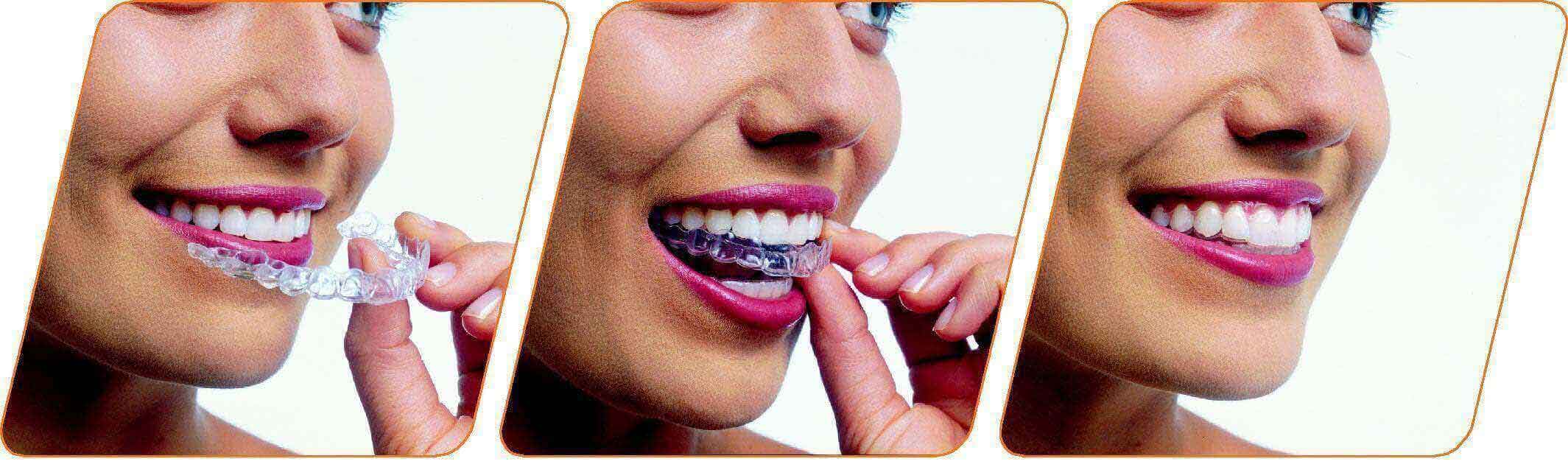 Invisible Braces Treatment