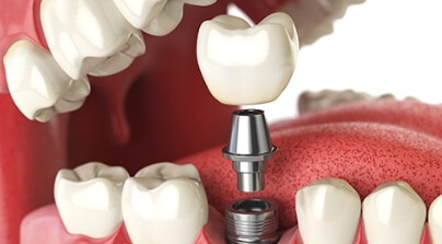 Dental Implants