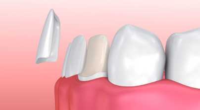 Dental Veneers