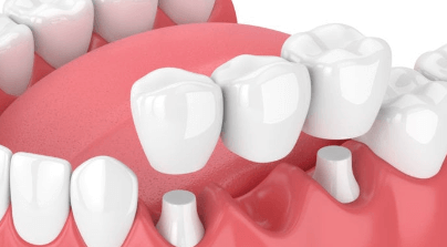 Dental Bridges