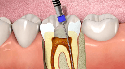 Root Canal Treatments