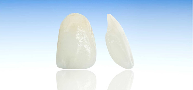 Ceramic Veneers