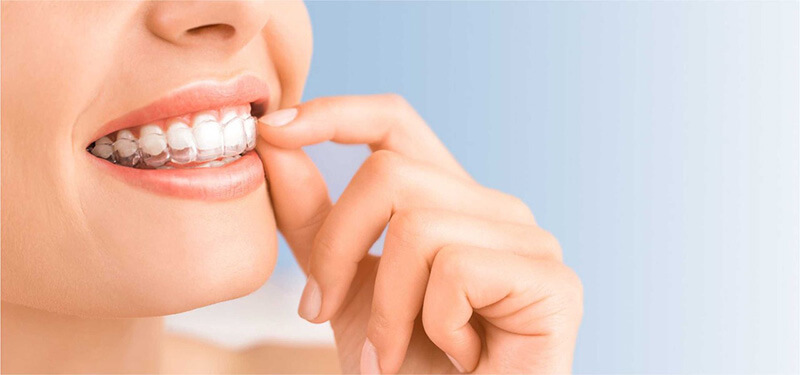 Invisible Braces