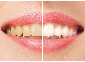 Instant Teeth Whitening