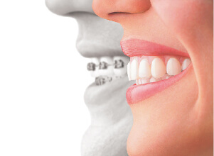 Invisible Braces Treatment